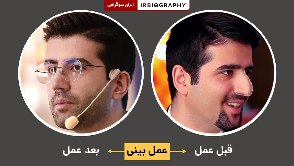 قبل و بعد از عمل بینی پیام بهرام پور