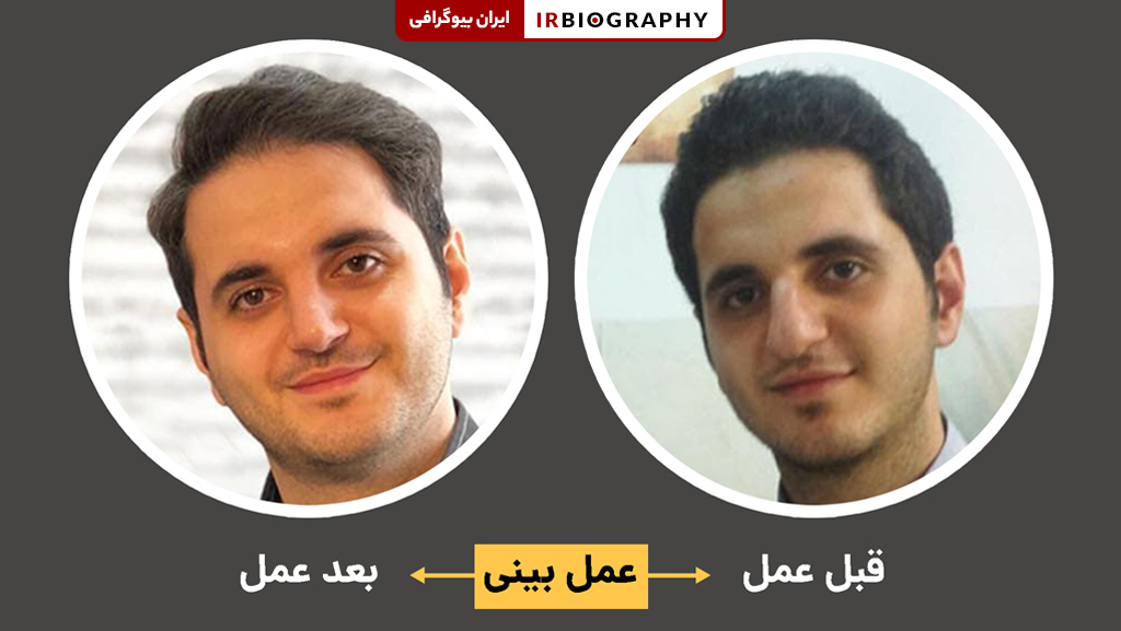 قبل و بعد از عمل بینی علی حاجی محمدی